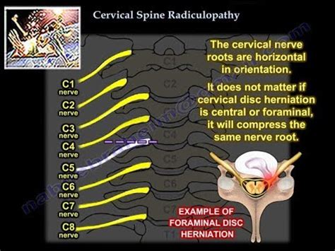 Radiculopathy - Zvirwere - 2022