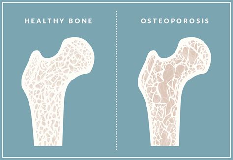 Learn Causes and Treatment of Osteoporosis - Post Pear