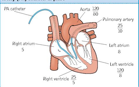 A practical guide to using pulmonary artery catheters. | Semantic Scholar