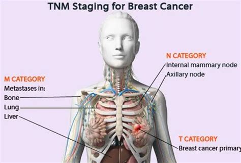 Understanding Cancer: Metastasis, Stages of Cancer, and More