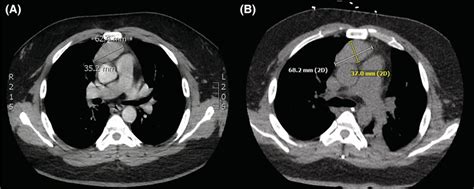 (A). Chest CT showing 6 × 3.5 cm anterior mediastinal mass consistent ...