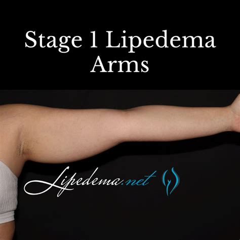 Learn About Stages and Types of Lipedema | Lipedema.net