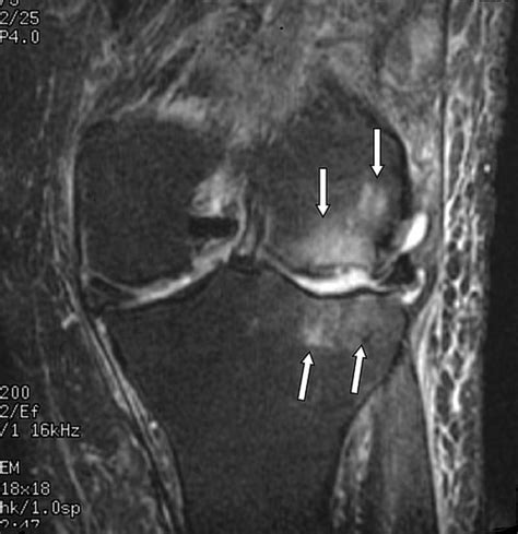 Bone Marrow Edema Syndrome