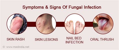 Fungal Infections - Causes, Symptoms, Diagnosis, Treatment & Prevention