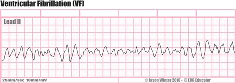 What is Ventricular Fibrillation (V-Fib)? - Boss RN