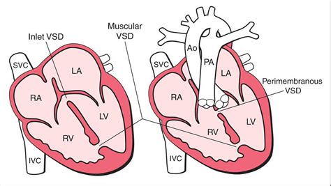 What is Congenital Heart Disease - Types, Causes, and Symptoms