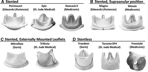 Transcatheter Aortic Valve Replacement for Bioprosthetic Aortic Valve ...