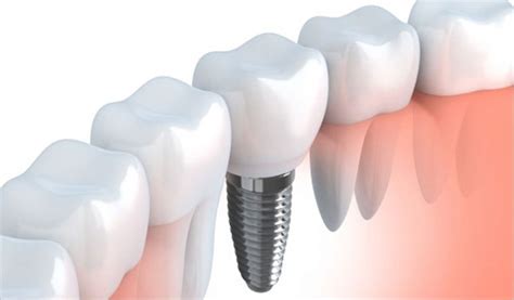 Obstructive Sleep Apnea Causes Complications in Dental Implants ...