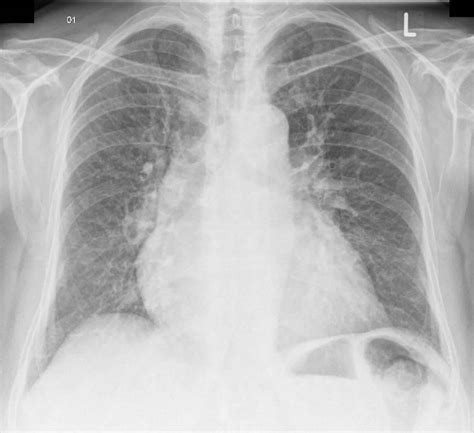 Vascular congestion definition & pulmonary vascular congestion