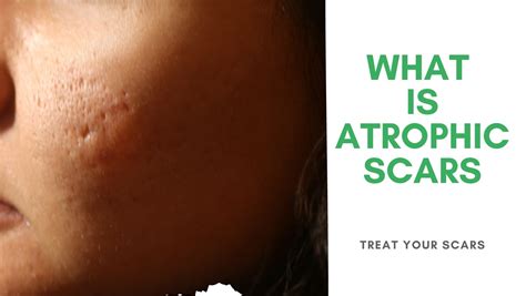 What Is Atrophic Scars - Treat Your Scars