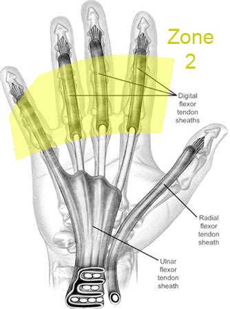 Flexor Tendon Injuries - Hand - Orthobullets