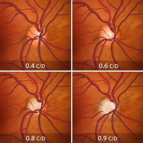 Optic nerve disease illustrations, stock eye marketing downloads