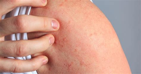 Scabies Rash: Treatment, Symptoms, Bites & How to Get Rid