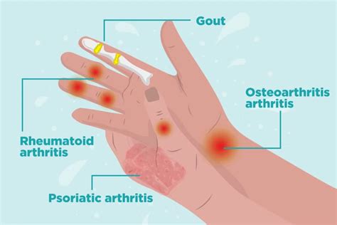 What Coping With Rheumatoid Arthritis Symptoms Signs and symptoms Signs ...