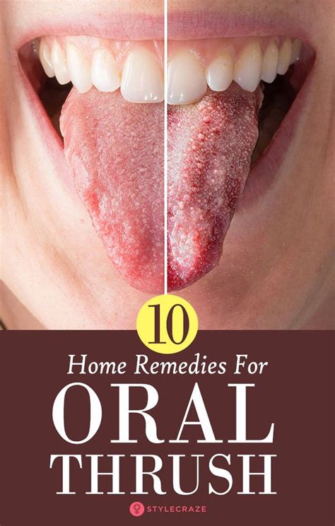 Oral Thrush In Adults Home Treatment