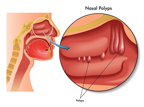 Nasal Polyps | Germany| PDF | PPT| Case Reports | Symptoms | Treatment