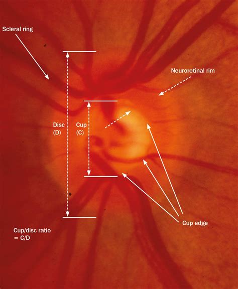 optic+disc | Community Eye Health Journal » The optic nerve head in ...