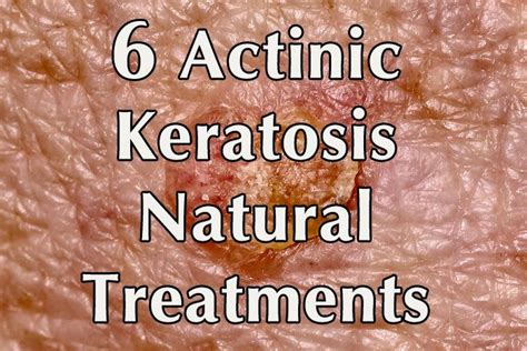 6 Actinic Keratosis Natural Treatments - Healthy Focus | Natural ...