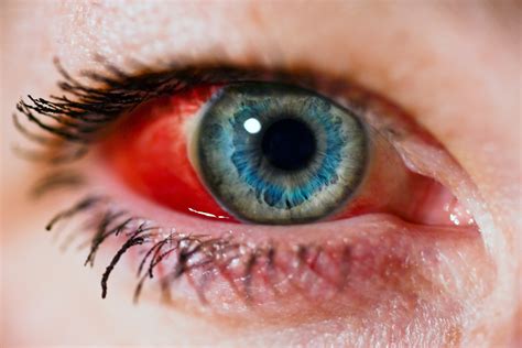 Subconjunctival Hemorrhage: Symptoms, Causes & Treatment