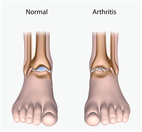 Ankle Arthritis – Ankle Fusion - Perth Orthopaedic Specialist Centre