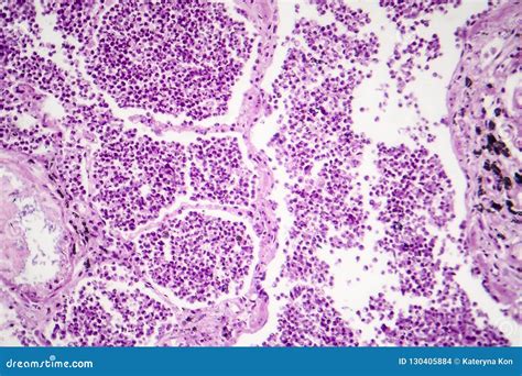 Lobar Pneumonia Histology