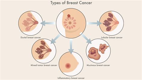 Understanding Different Types of Breast Cancer