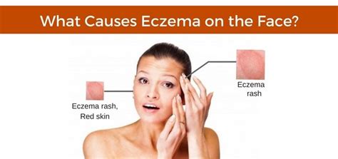 Eczema On Face Treatment - Doctor Heck