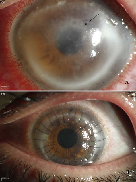 Acanthamoeba keratitis causes, signs, symptoms, diagnosis, treatment ...