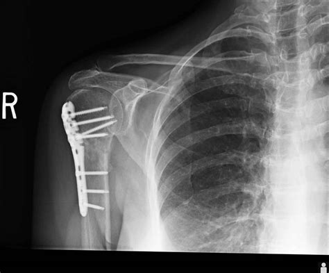 Clavicle Fracture Surgery | Shoulder Surgeon | Santa Barbara, Santa ...