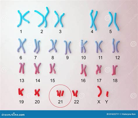 Down-syndrome Karyotype Royalty-Free Illustration | CartoonDealer.com ...