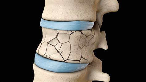 Why Kyphoplasty is the Best Option for Spinal Compression Fractures ...