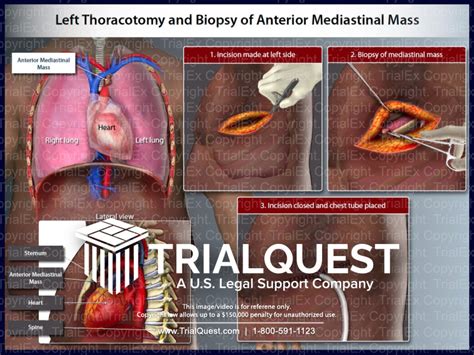 Left Thoracotomy and Biopsy of Anterior Mediastinal Mass ...