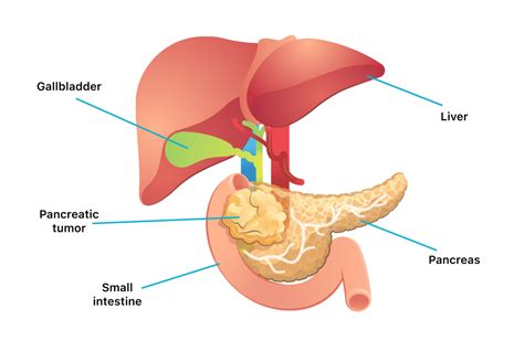 Pancreatic Cancer | Symptoms, Causes, Types, Stages and Treatment