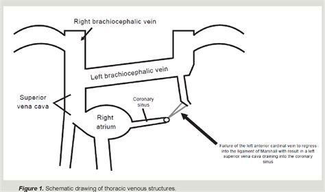 Figure 1 from Persistent left-sided superior vena cava | Semantic Scholar