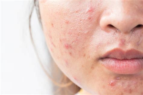 Acne Images – Browse 182,584 Stock Photos, Vectors, and Video | Adobe Stock