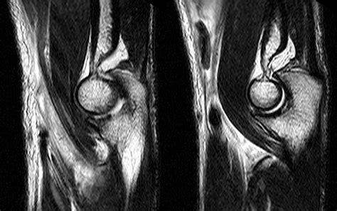 Distal Biceps Tendon Rupture Elbow - Radsource