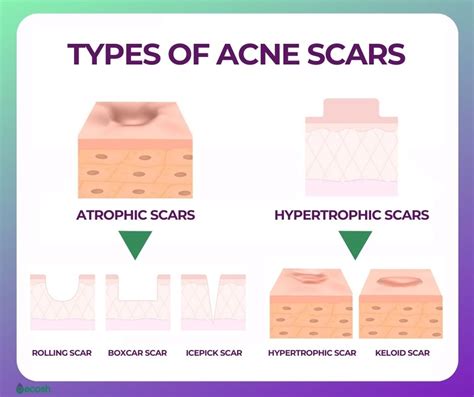 ACNE SCARS - Types of Acne Scars And Acne Scars Treatment - Ecosh