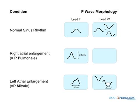 P Wave Morphology - ECGpedia