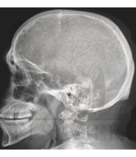 Skull: Lateral Radiograph