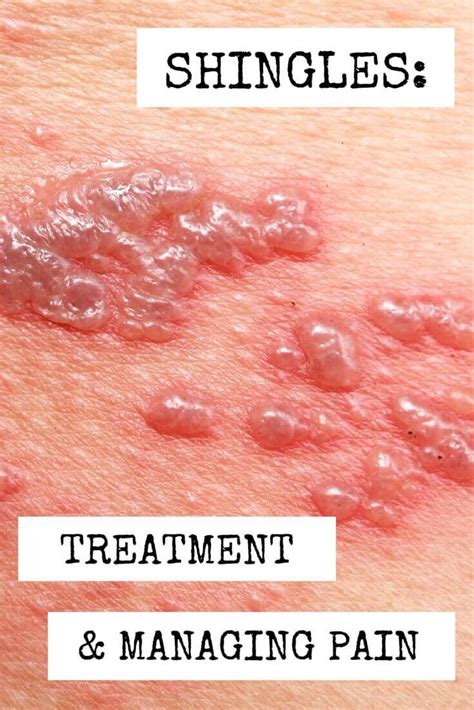 Shingles: Treatment and Managing Pain - WCEI - Blog WCEI – Blog