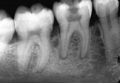 Periapical periodontitis; Periodontitis, Apical; Periodontitis, Acute ...