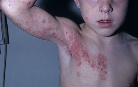 Shingles Rash Images On Back