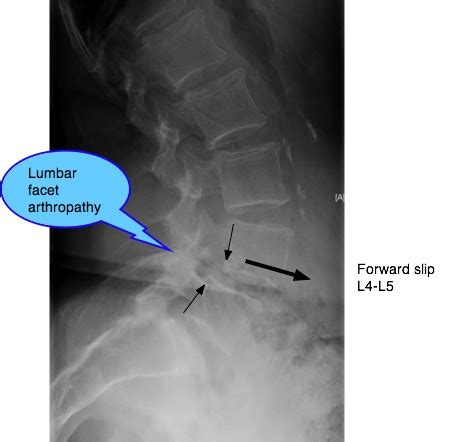 What Causes Facet Joint Hypertrophy With Cyst