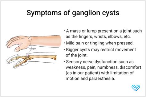 Ganglion Cyst Causes Sign And Symptoms Diagnosis And Treatment – NBKomputer