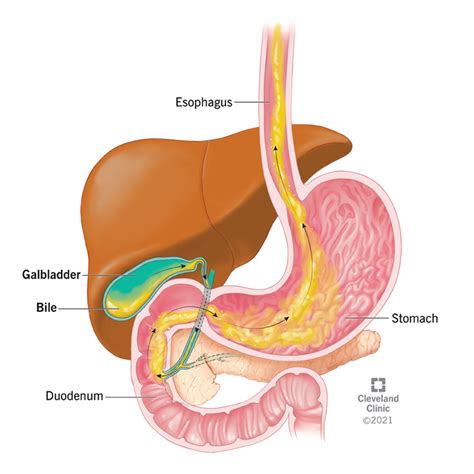 Bile Reflux: Symptoms, Treatment, Causes & What It Is