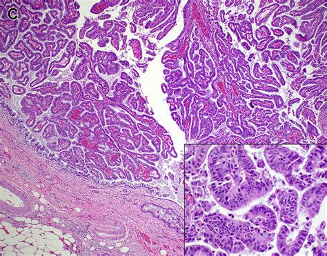 Cholangiocarcinoma - Surgical Pathology Clinics