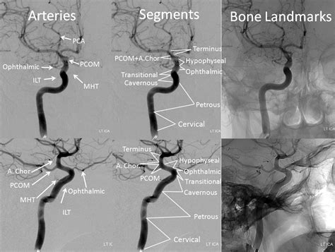 Internal Carotid Artery Segments