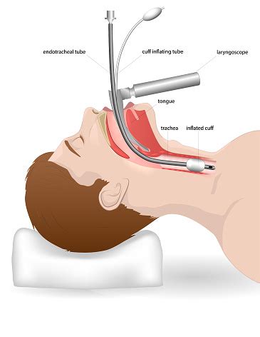 Intubation For A Patient With Respiratory Arrest Or Difficulty In ...