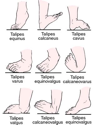 Valgus deformity | definition of Valgus deformity by Medical dictionary