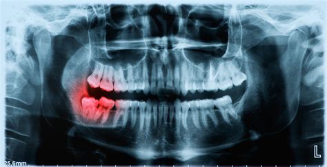 Abscessed Wisdom Tooth Xray